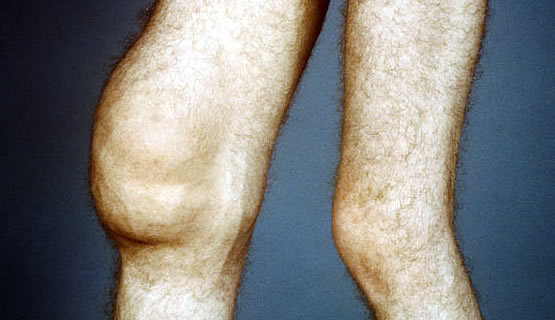 Изображение - Какиспол редькуприсиновите колен сустава sinovit-kolena