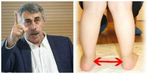 Детский доктор Комаровский о вальгусной деформации голени у детей
