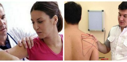 Защемление плечевого нерва: как лечить и определить симптомы