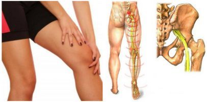 Как лечить защемление нерва в ноге: причины, симптомы, упражнения