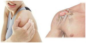 Защемление плечевого нерва симптомы и лечение