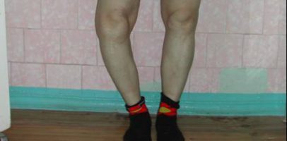 Вальгусная деформация коленных суставов: лечение и массаж