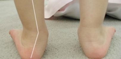 Лечение вальгусной деформации стопы у детей: массаж, упражнения, гимнастика и ЛФК.