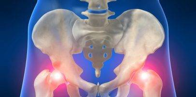Виды и методы лечения перелома тазобедренного сустава
