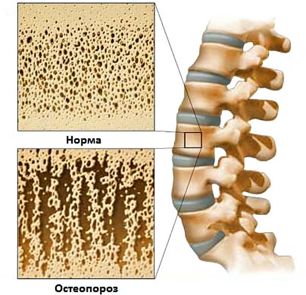 Профилактика остеопороза в пожилом возрасте